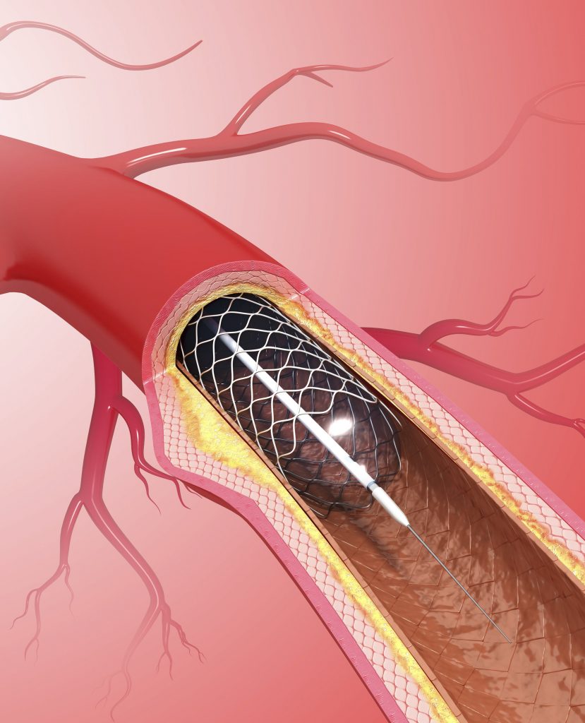 Coronary Angioplasty In Singapore | The Heart Doctors Clinic