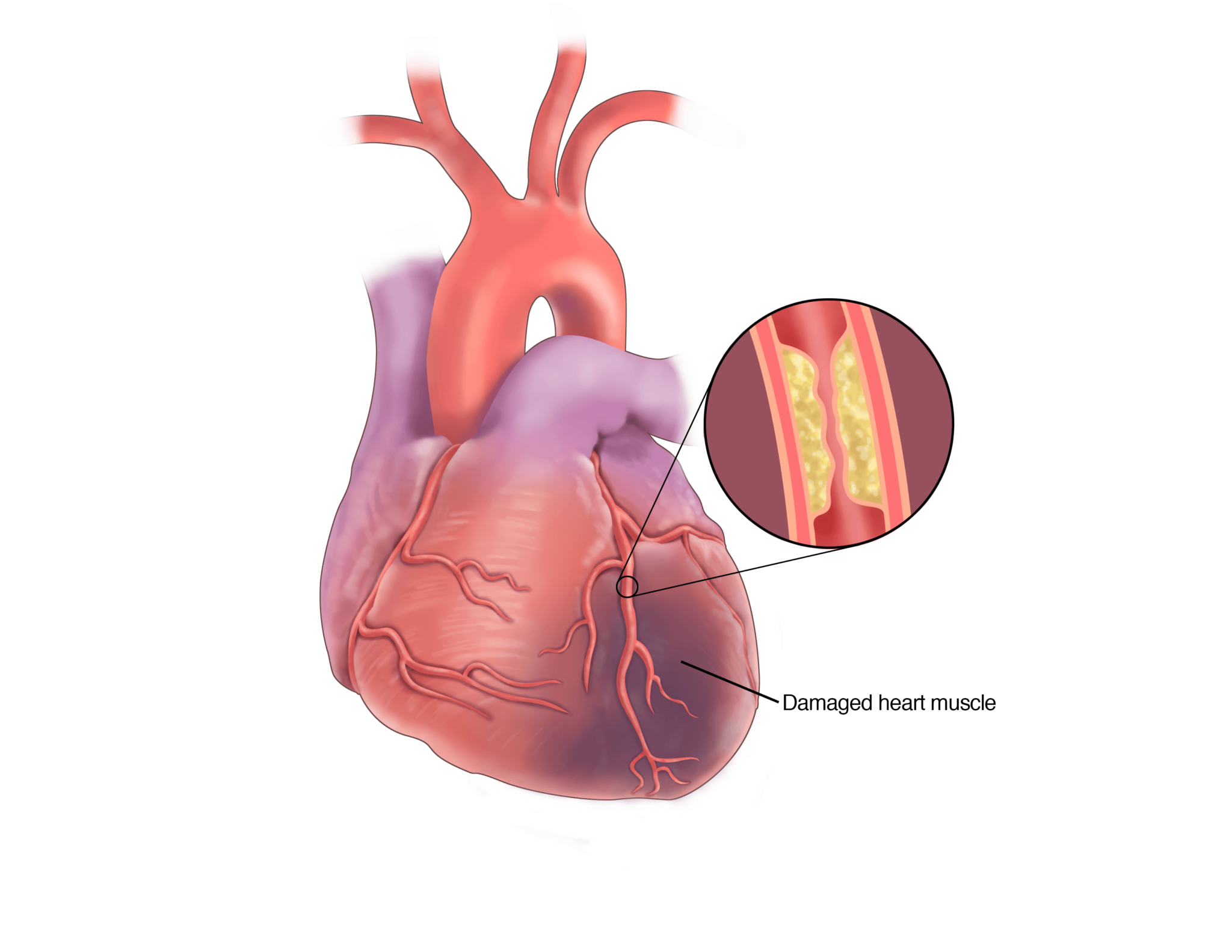 WHAT IS CORONARY HEART DISEASE visual data 8